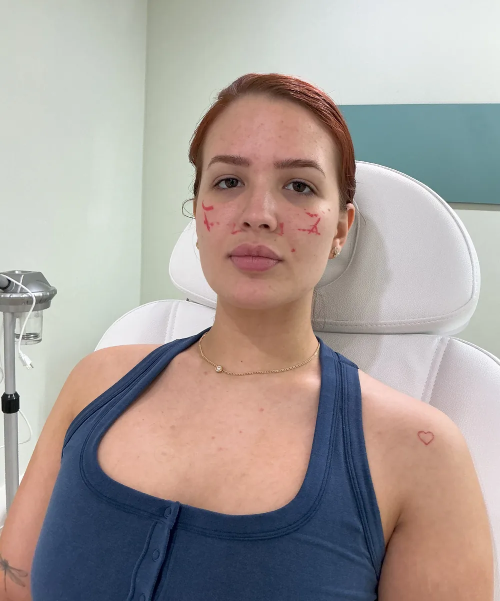 Antes del tratamiento EZ Gel