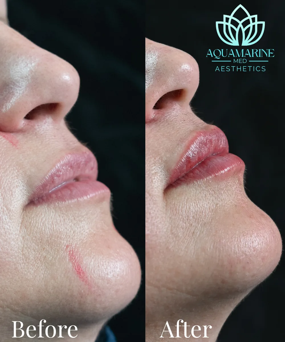 Resultado de armonizacion facial natural