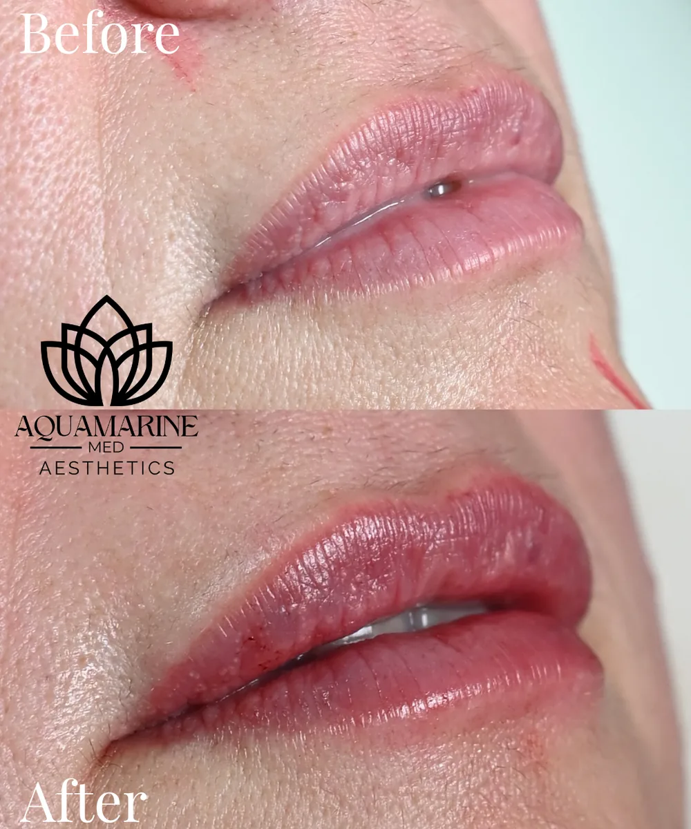 Before and after de labios en primer plano