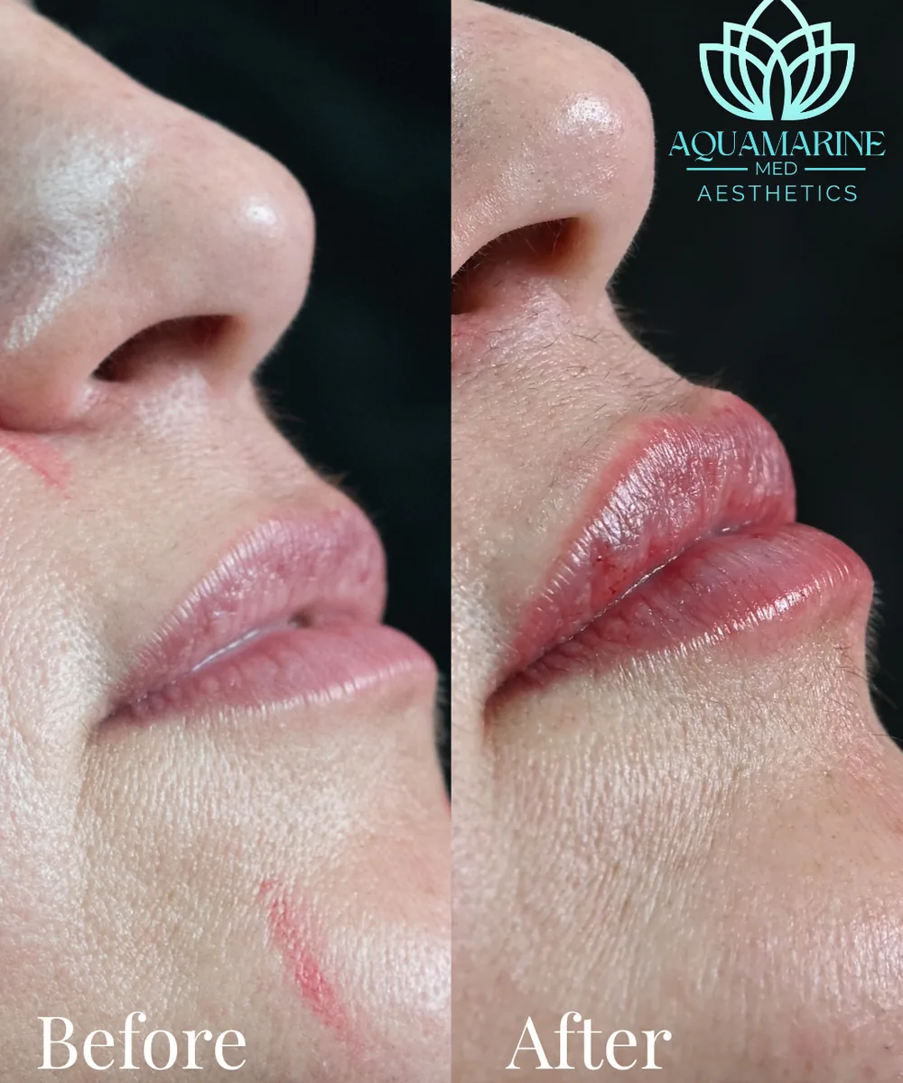 Antes y después de aumento de labios