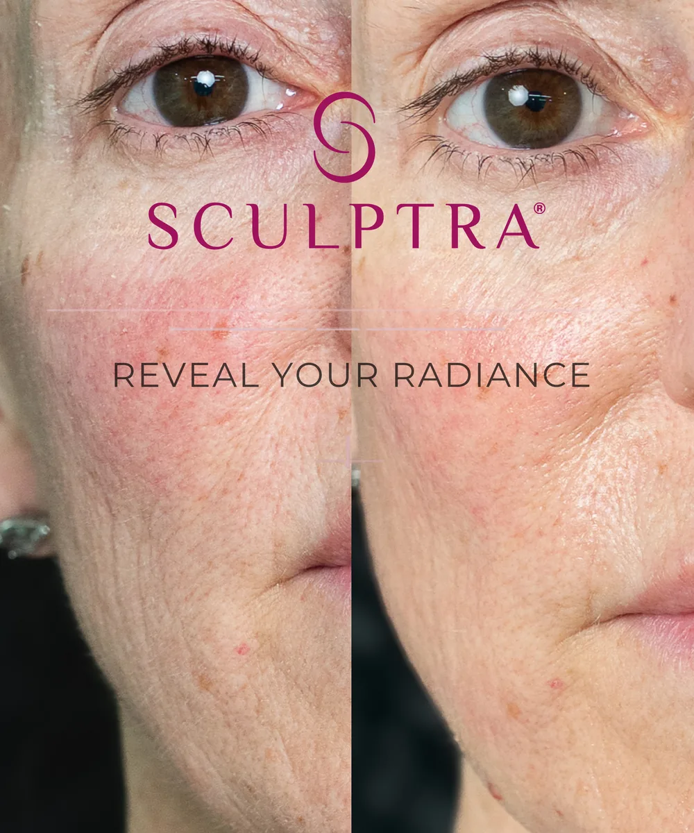 Antes y después de tratamiento con Sculptra