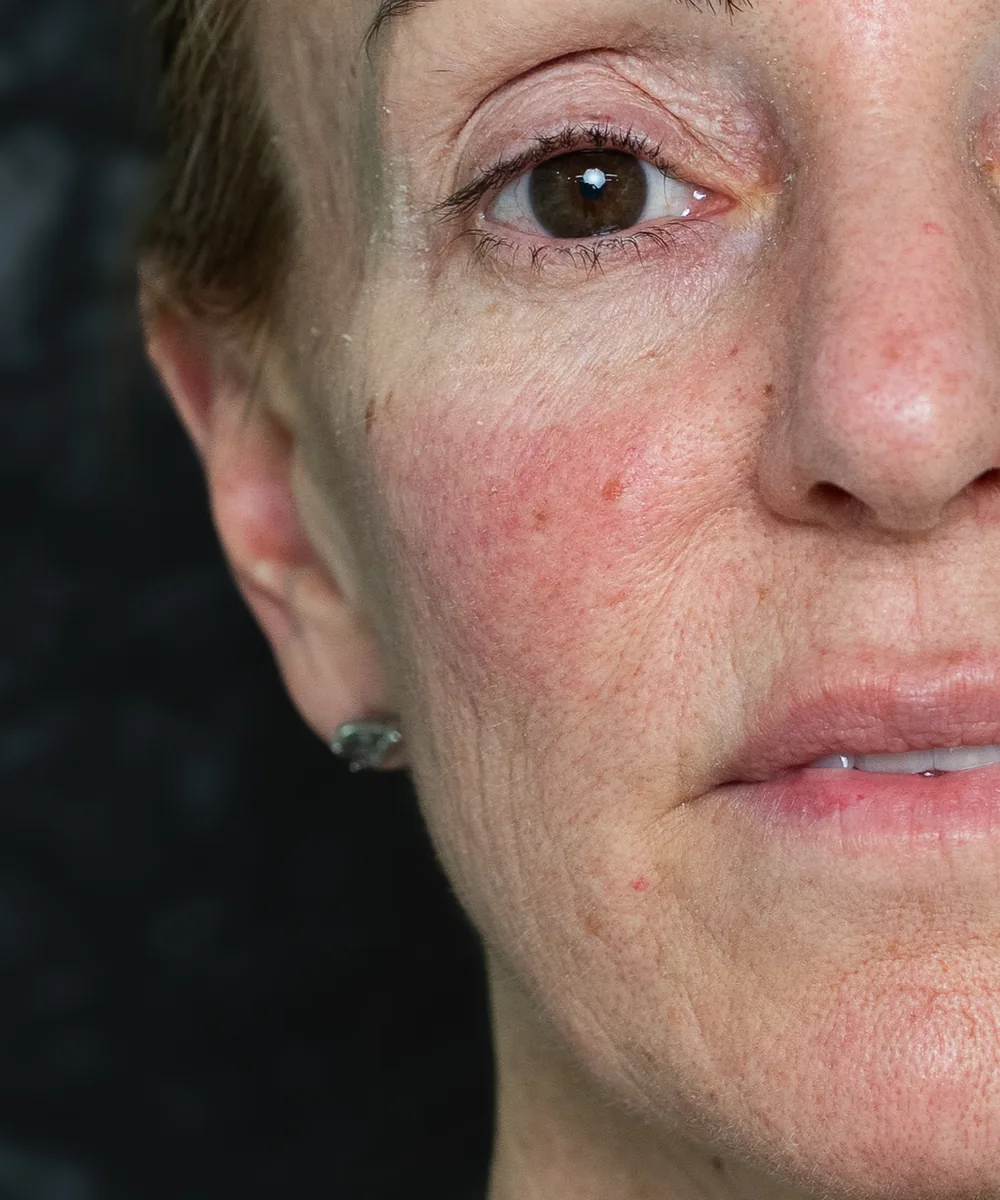 Resultado con bioestimulacion Sculptra