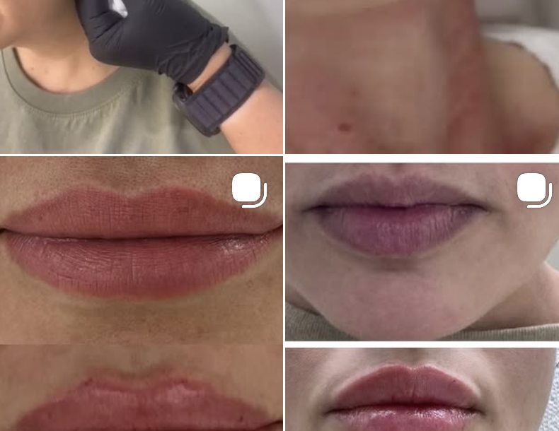 Resultado natural de labios